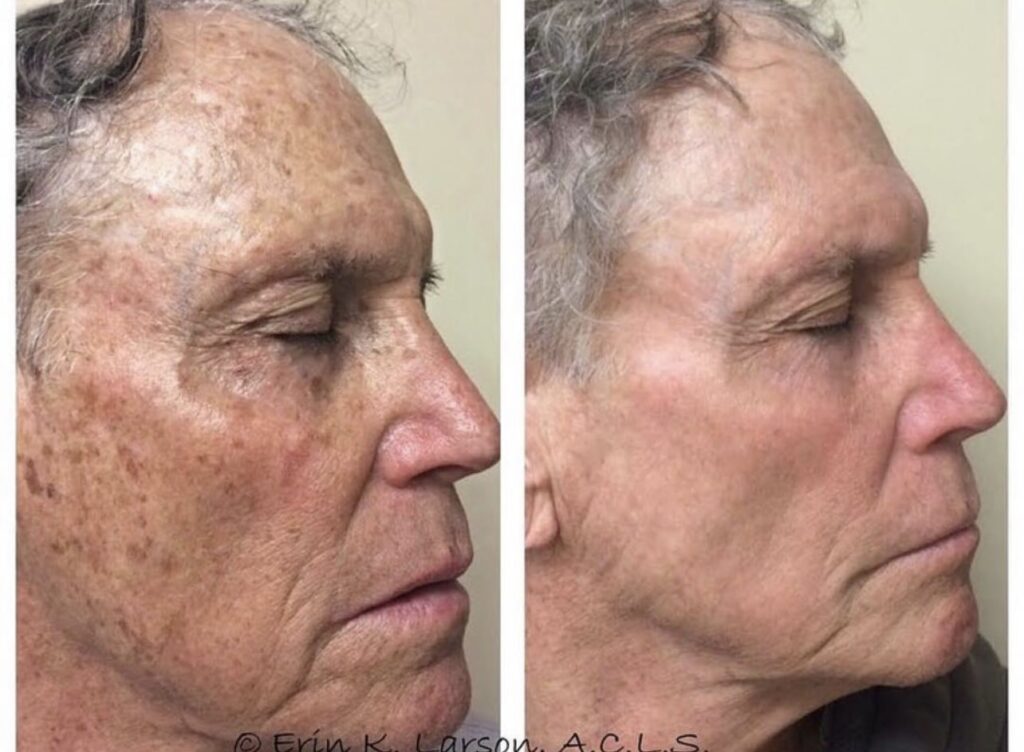 vaginal rejuvenation treatment